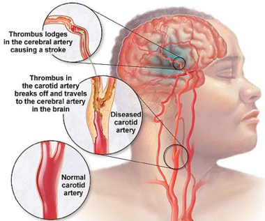 severed carotid artery in brain